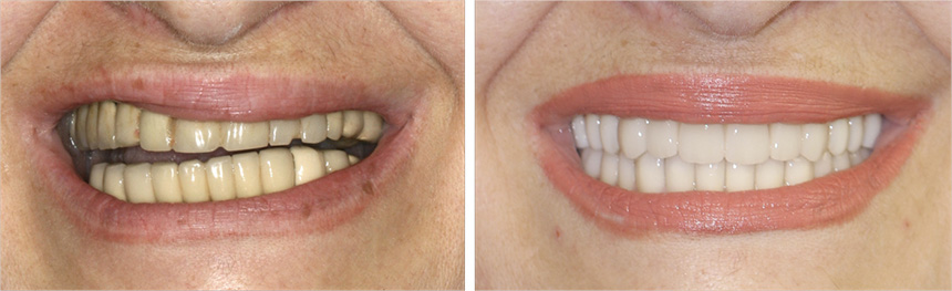 10038 Dental Implants